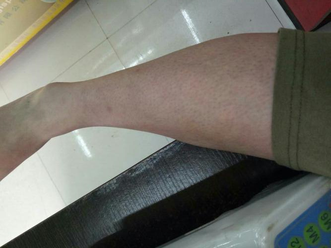 脚底出现一个红点是手足口病吗